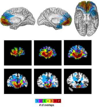Lesion Maps koenigs lab